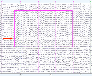 7: Inspección del EEG e interpolación de canales defectuosos